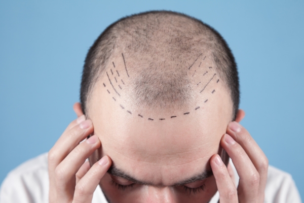 Hair Transplant Treatment image 1